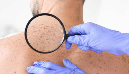 Tip pre zdravie: Navštívte dermatologa